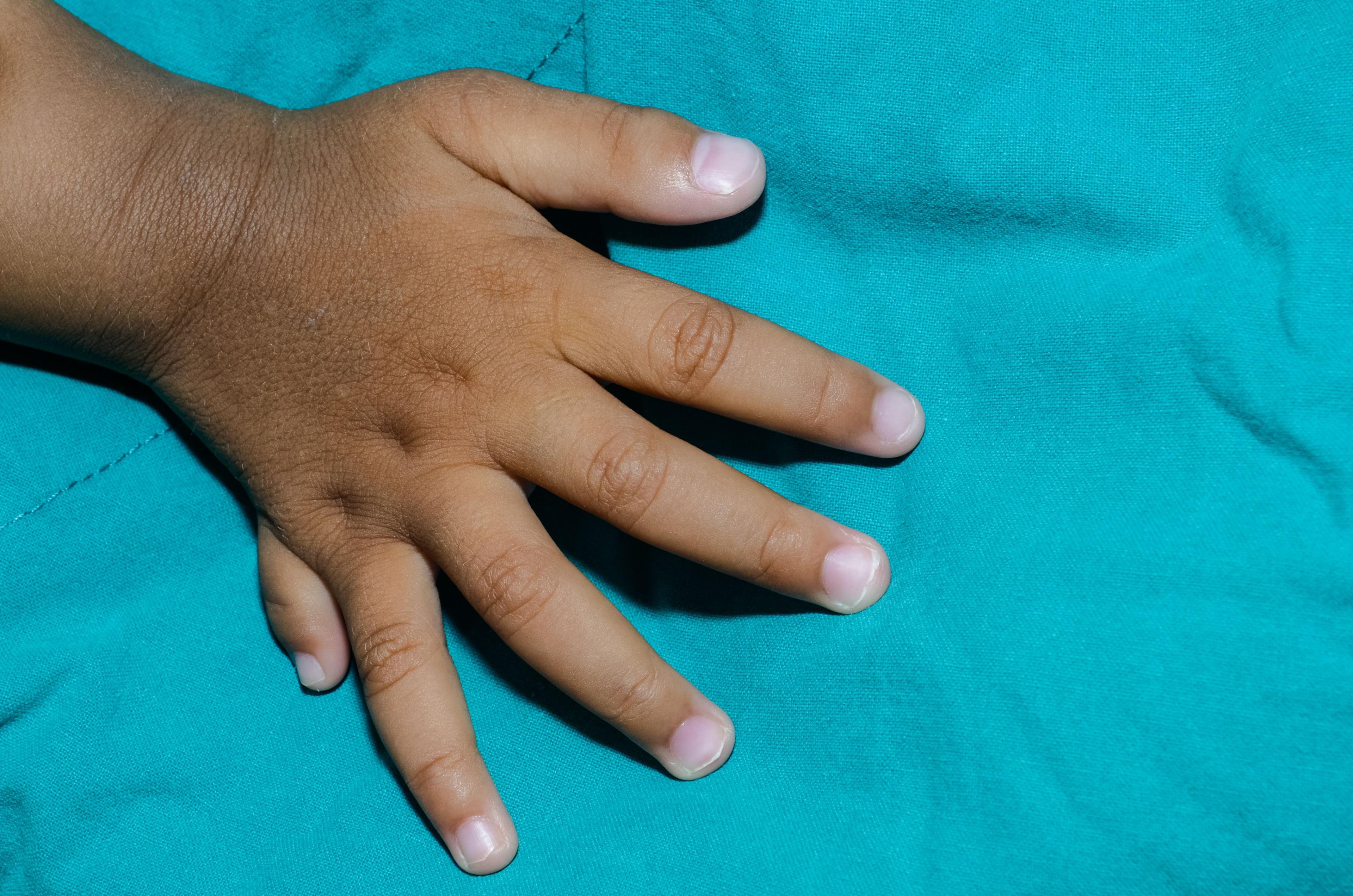 Ett barns hand med ett extra lillfinger.