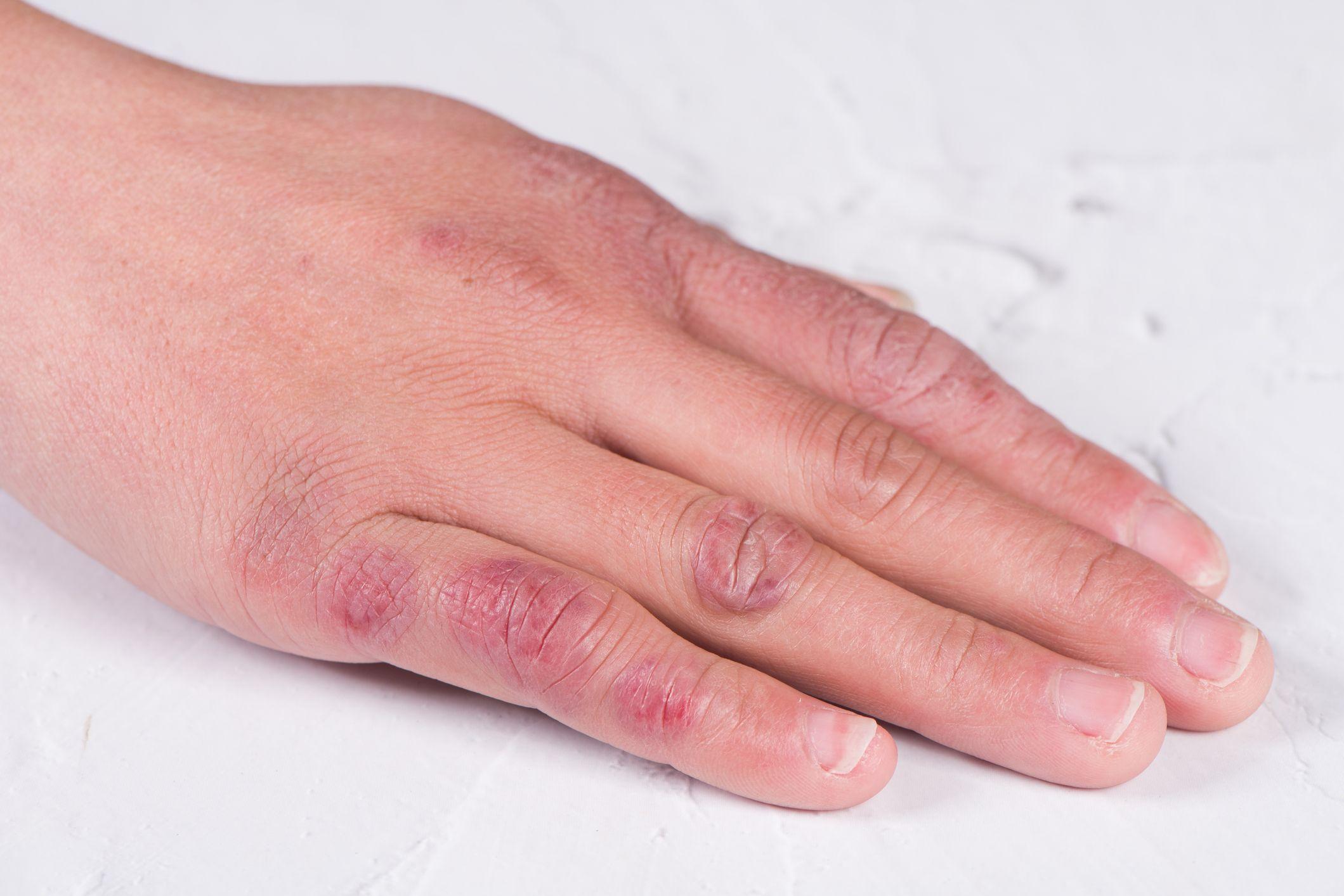 En ung flickas hand med röda och mörka fläckar. Köldskada.