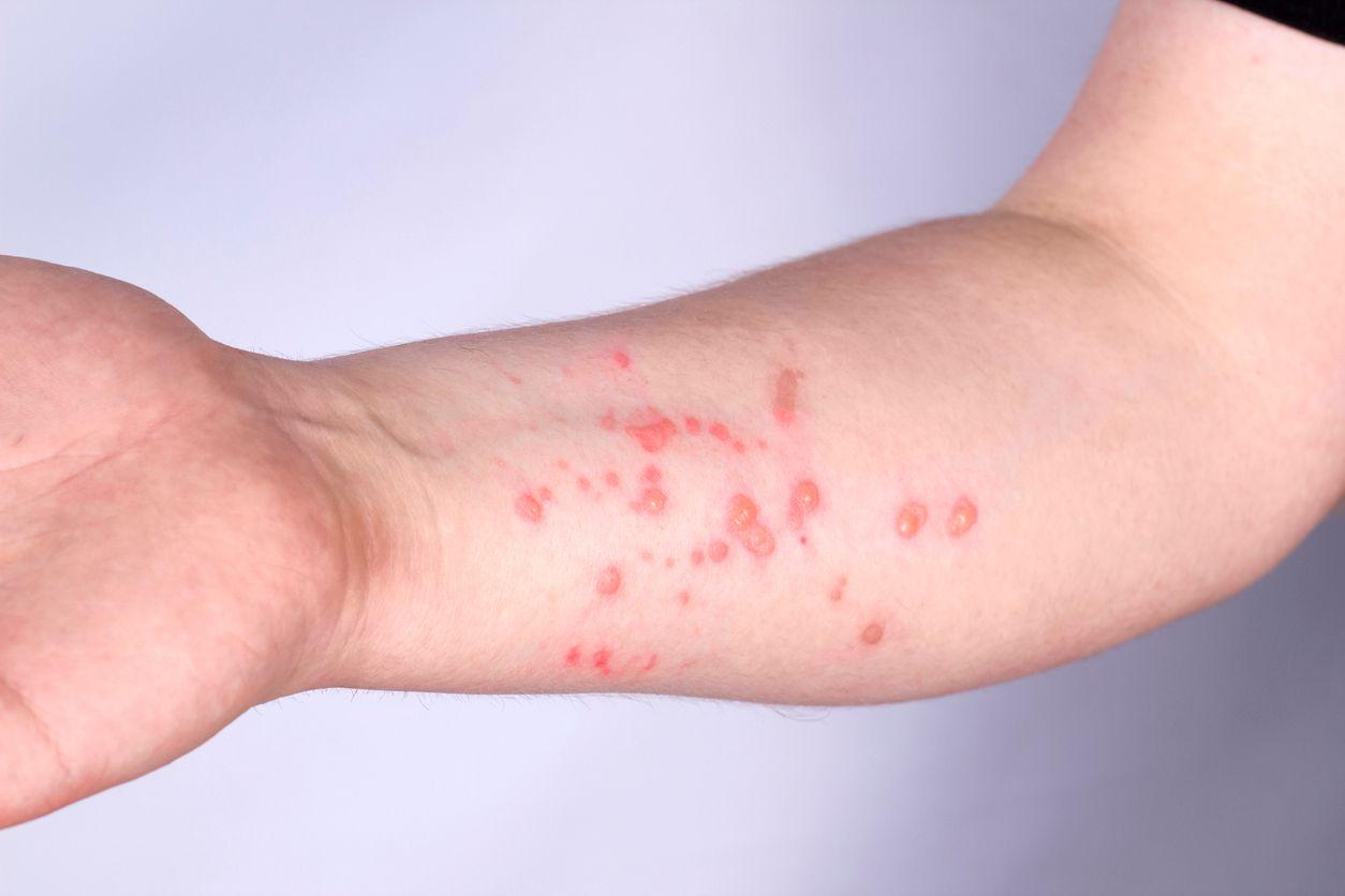 Blåsor av mpox på undersidan av en arm
