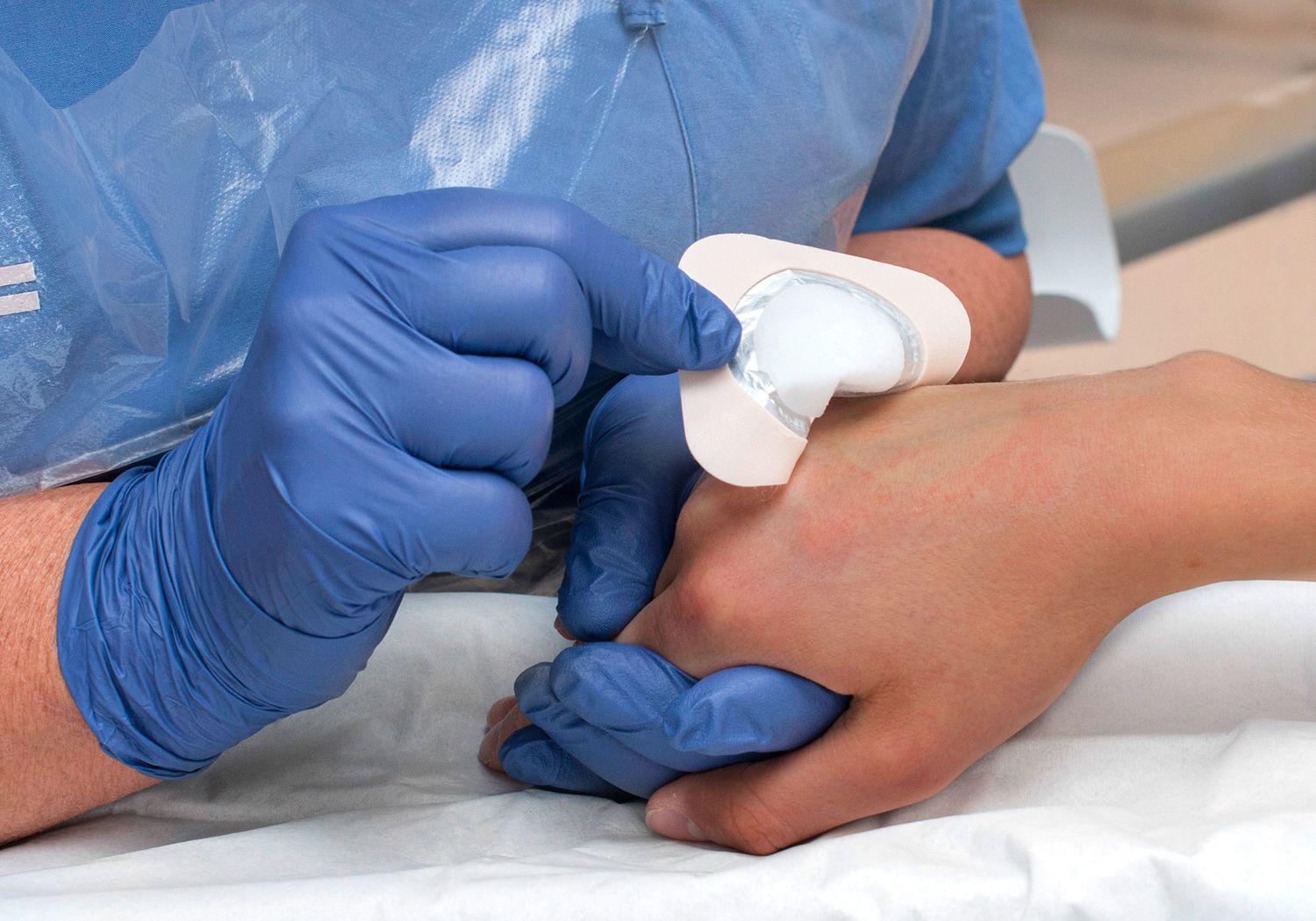 Sjuksköterska i blå handskar tar bort ett bedövningsplåster från en flickas handrygg.