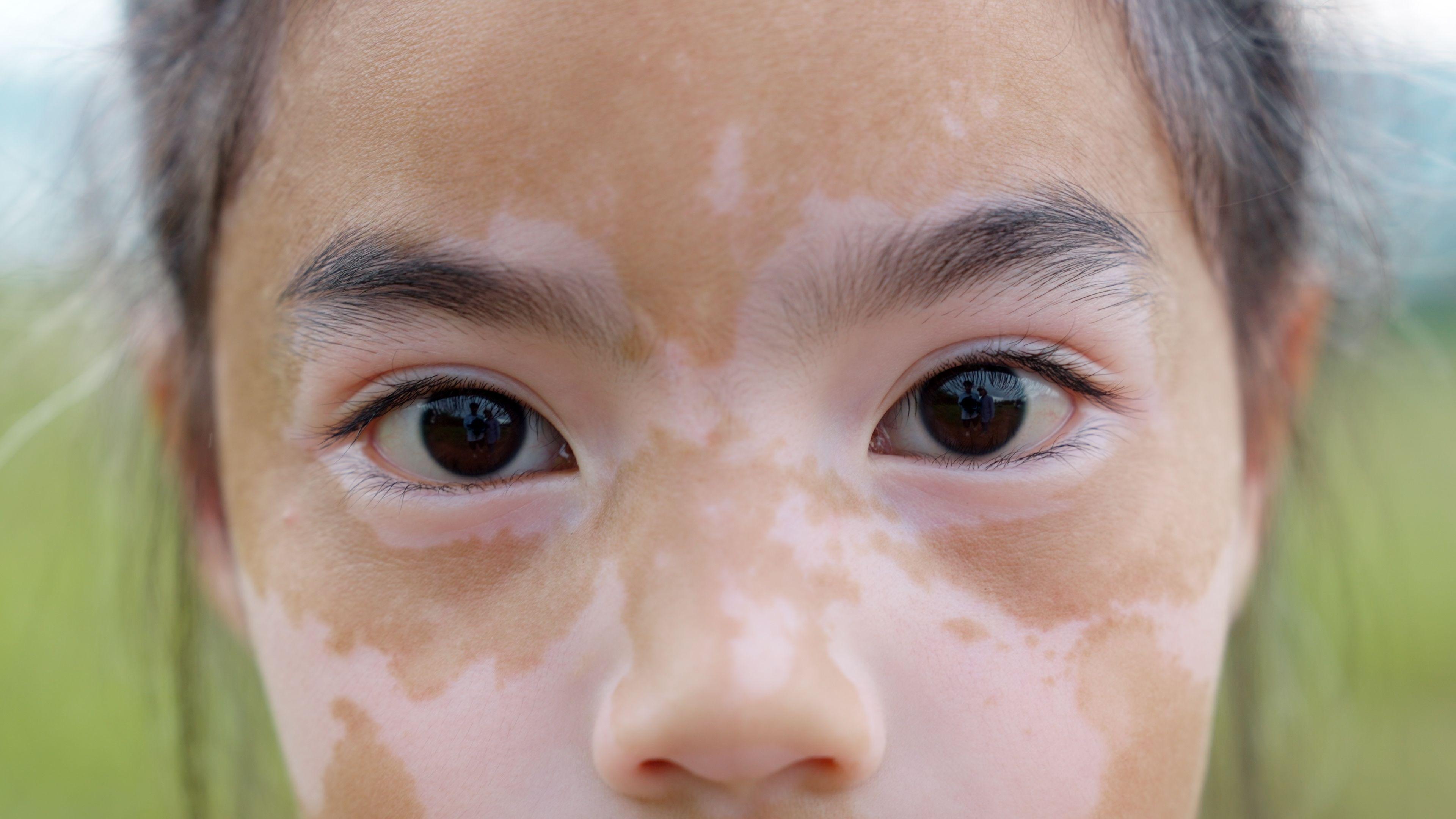 Fläckar av vitiligo i ansiktet på en flicka.