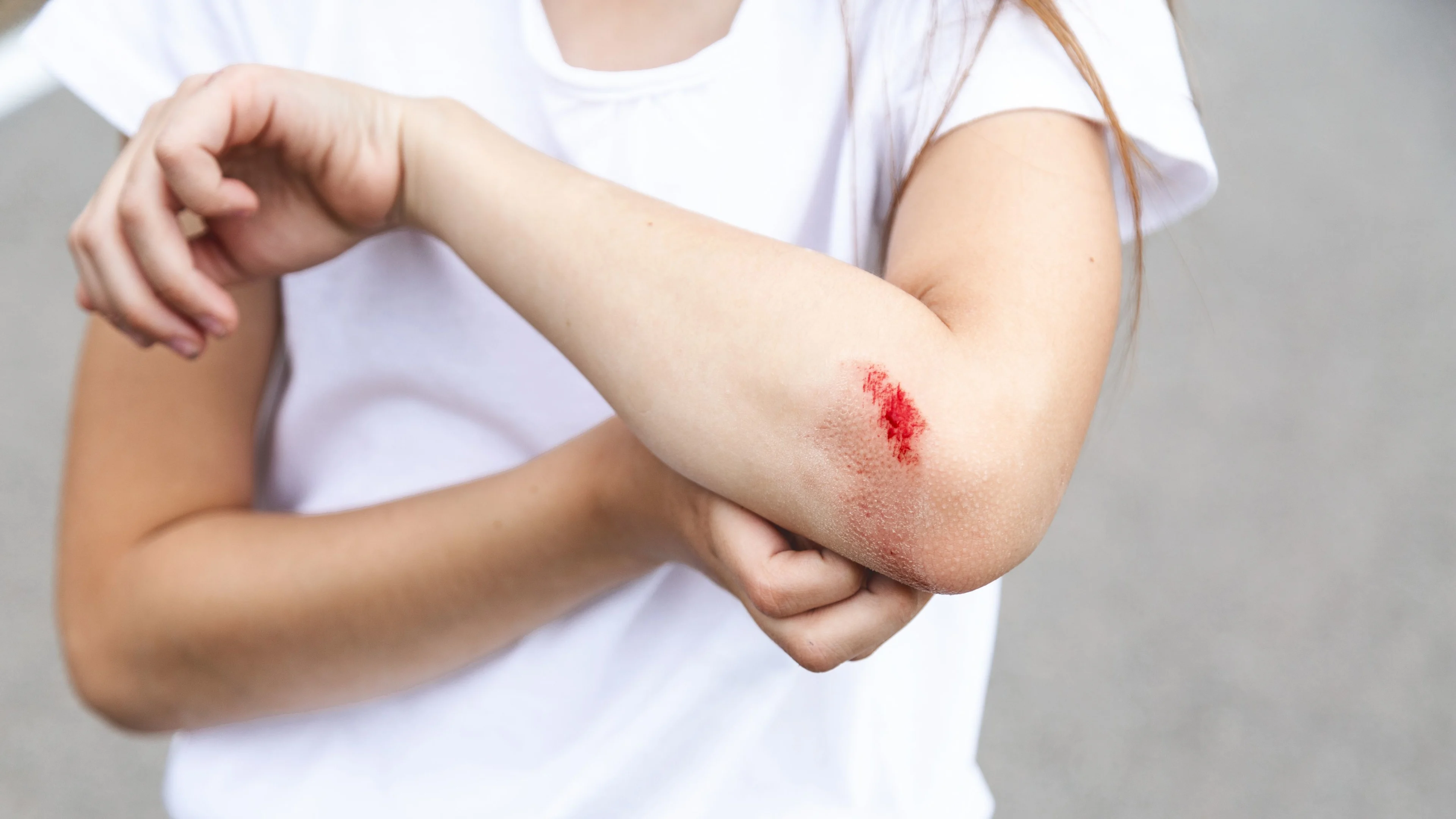 En flicka i vit t-shirt har ett sår på armen som blöder.