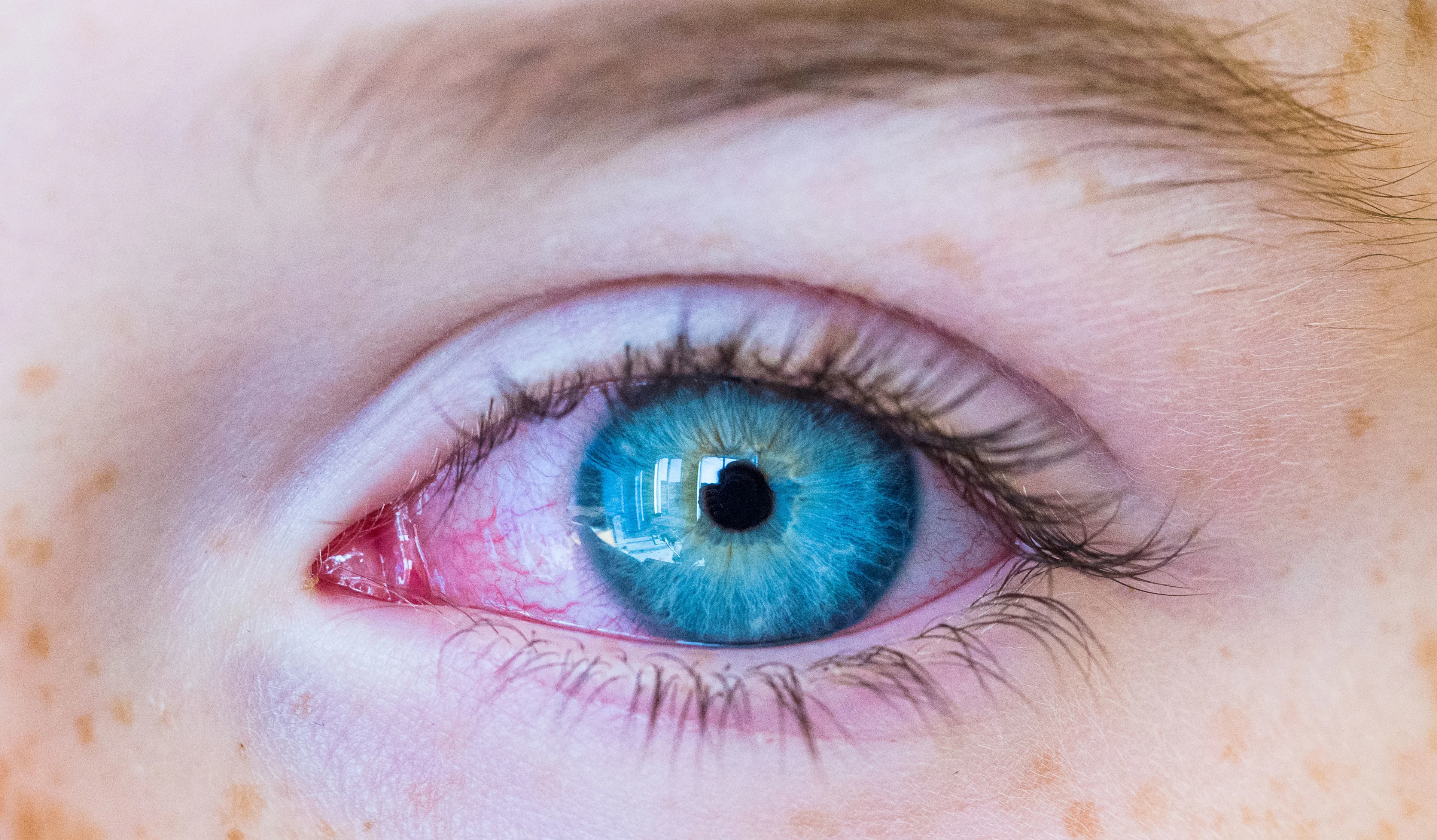 Ett öga som är rött och irriterat.