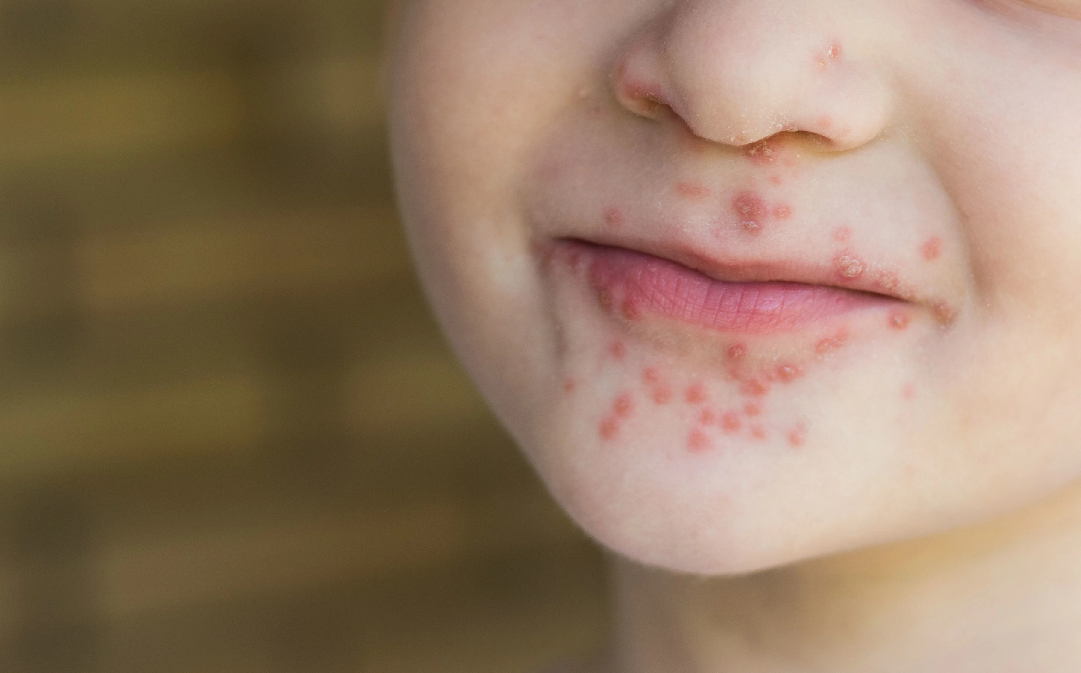 Höstblåsor runt munnen på ett barn.