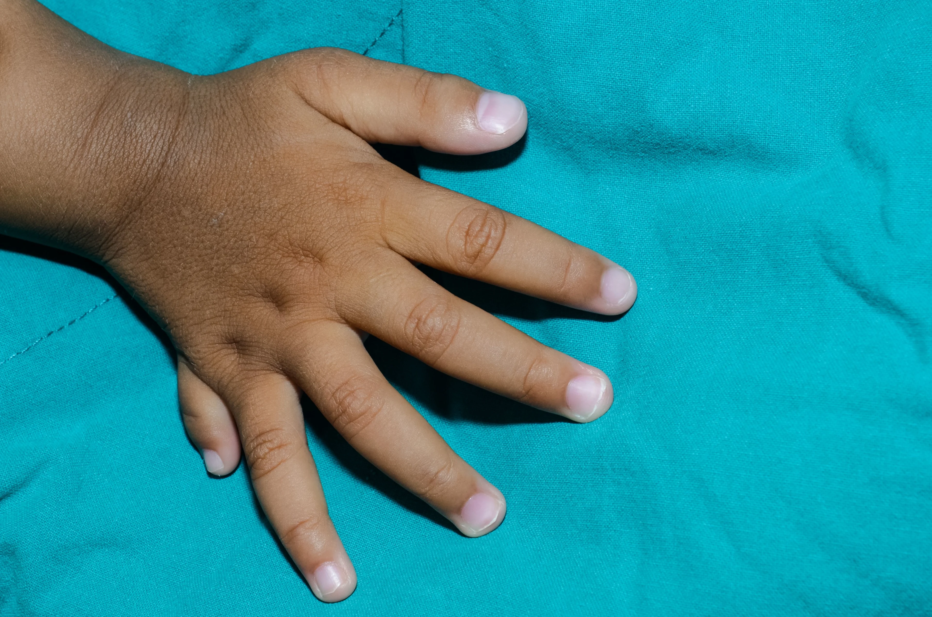 Ett barns hand med ett extra lillfinger.