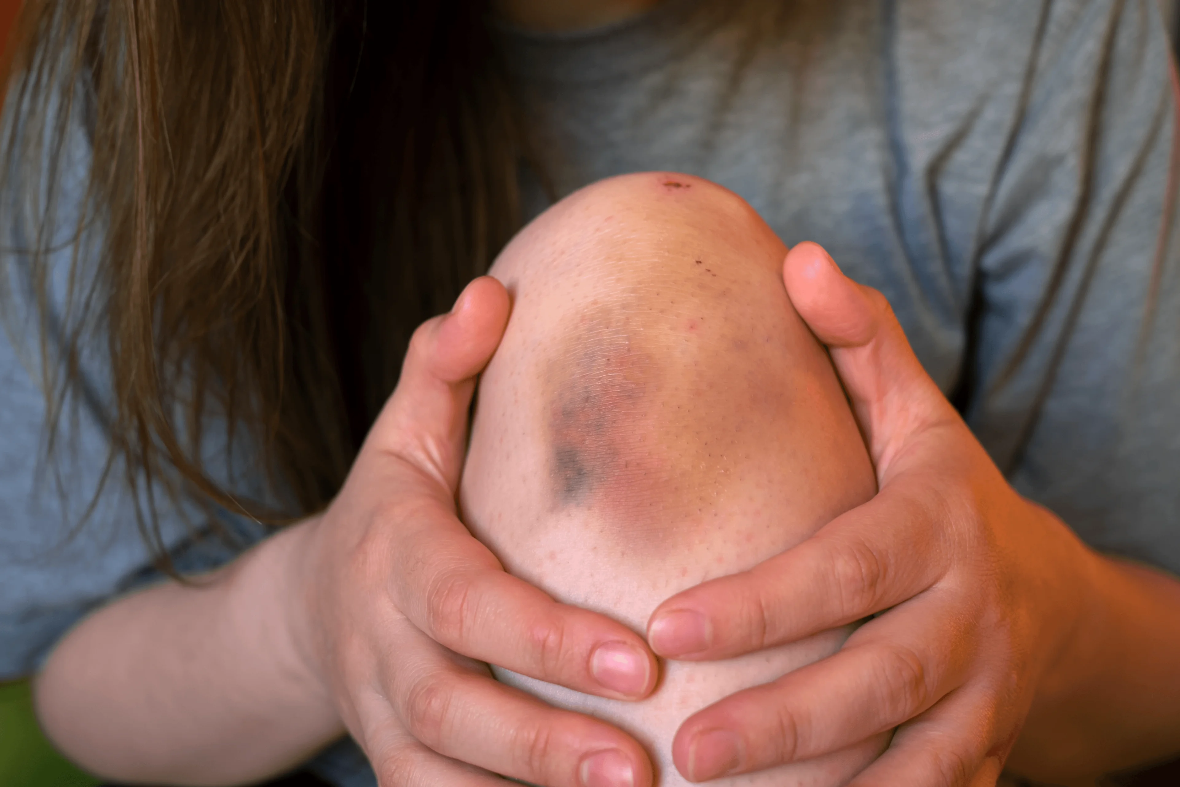 Blåmärke på ett knä