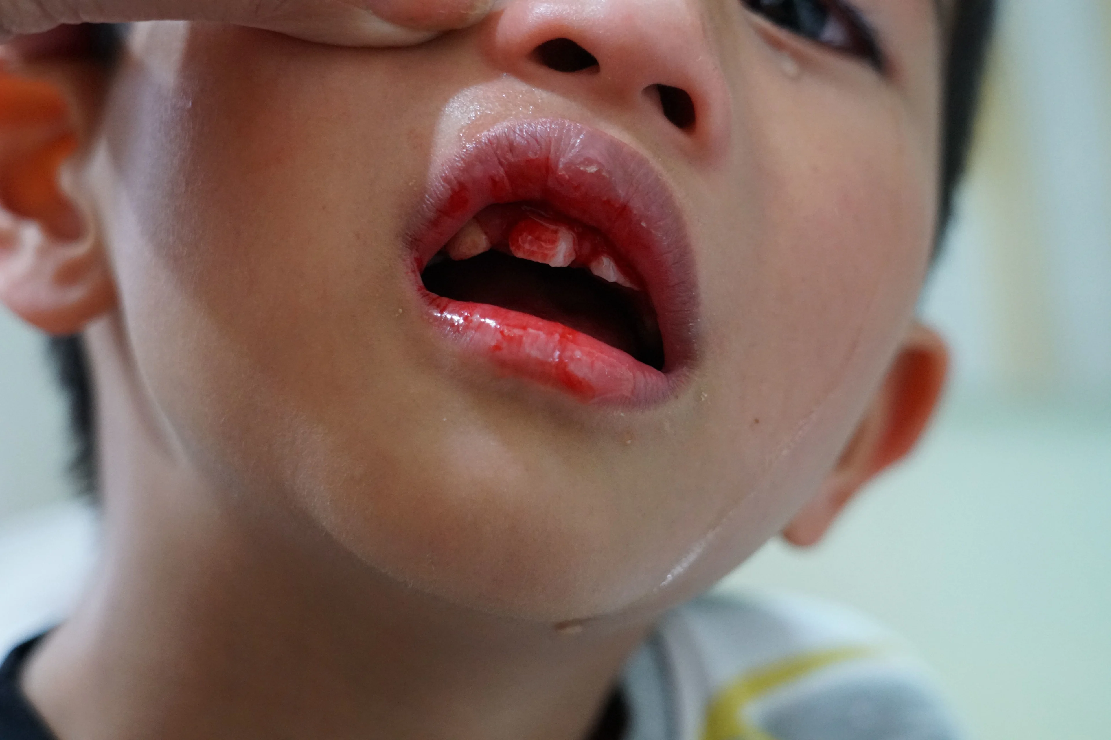 En pojke har skadat en tand i överkäken. Tanden är lös och det blöder i munnen.