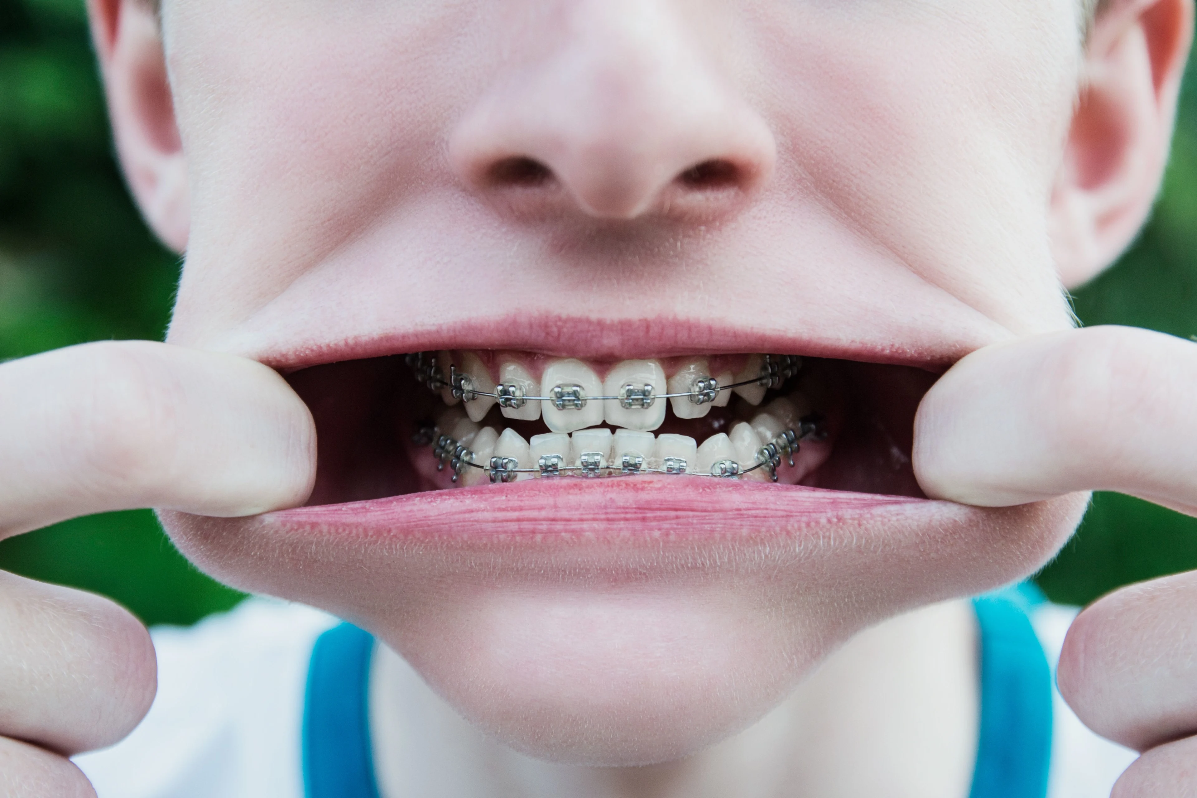 en pojke gapar stort. Han har tandställning på tänderna både uppe och nere i munnen.