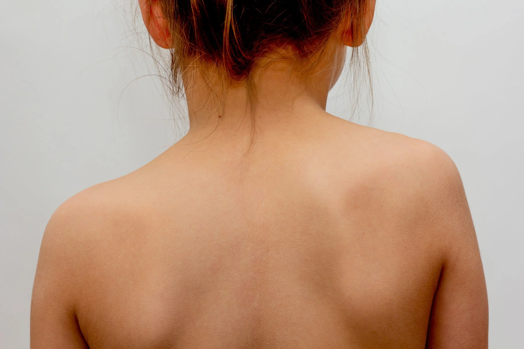 En flicka med mört hår är fotograferad bakifrån. Hennes rygg är sned.