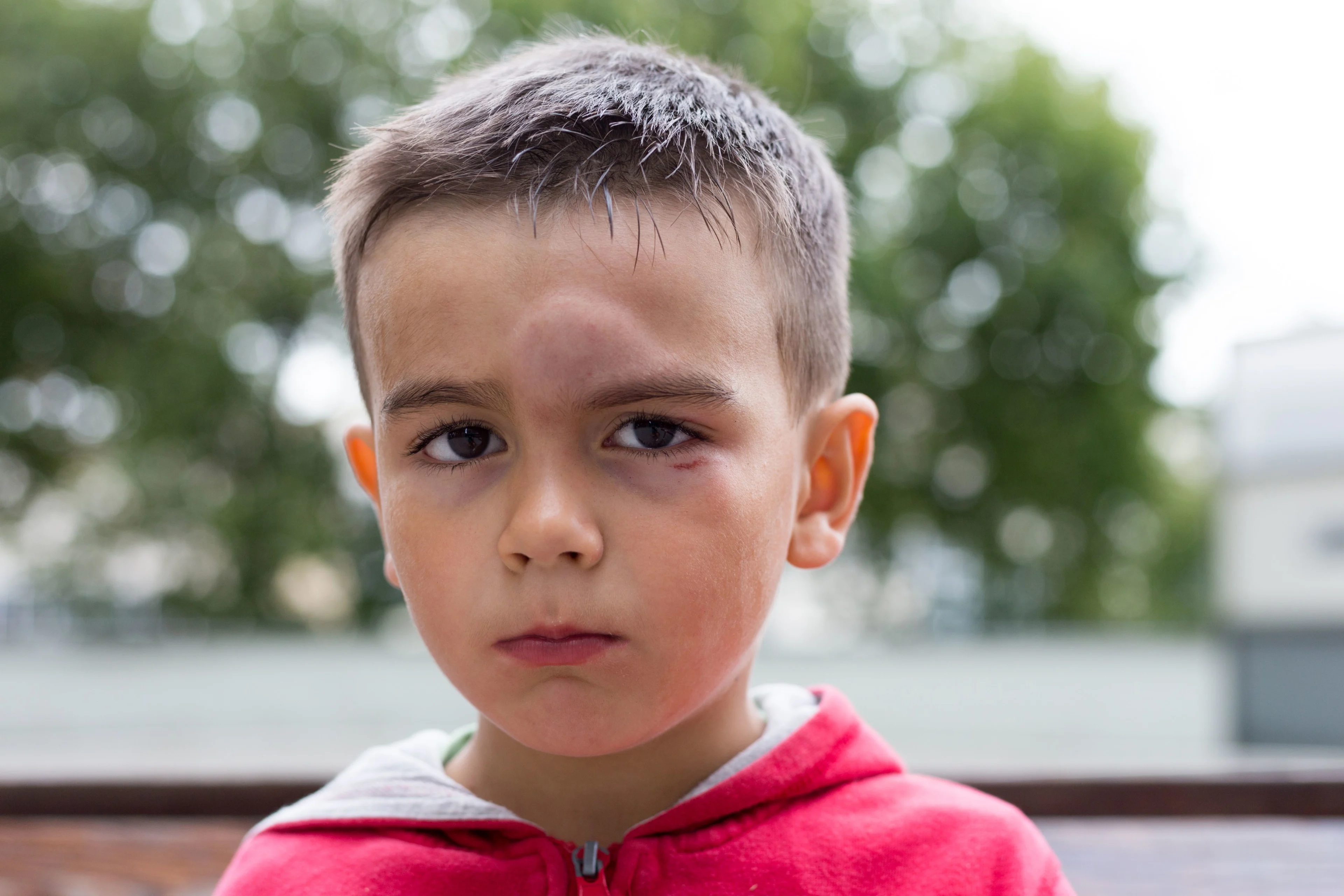 Pojke i röd tröja och med mörkt hår har en bulda i pannan. Pojken ser ledsen ut.