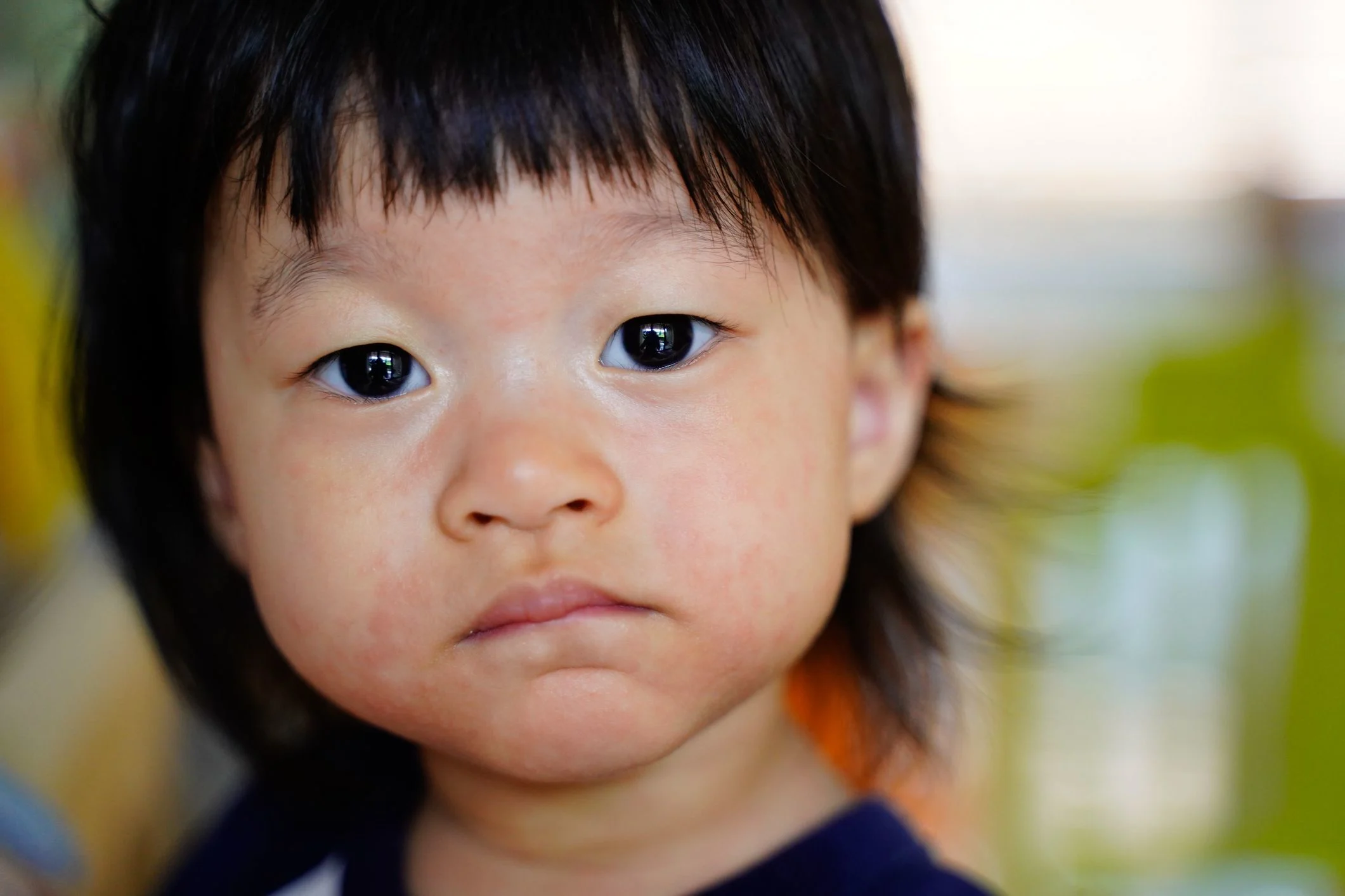 En asiatisk flicka med märkt kort hår har röda utslag i anskitet.