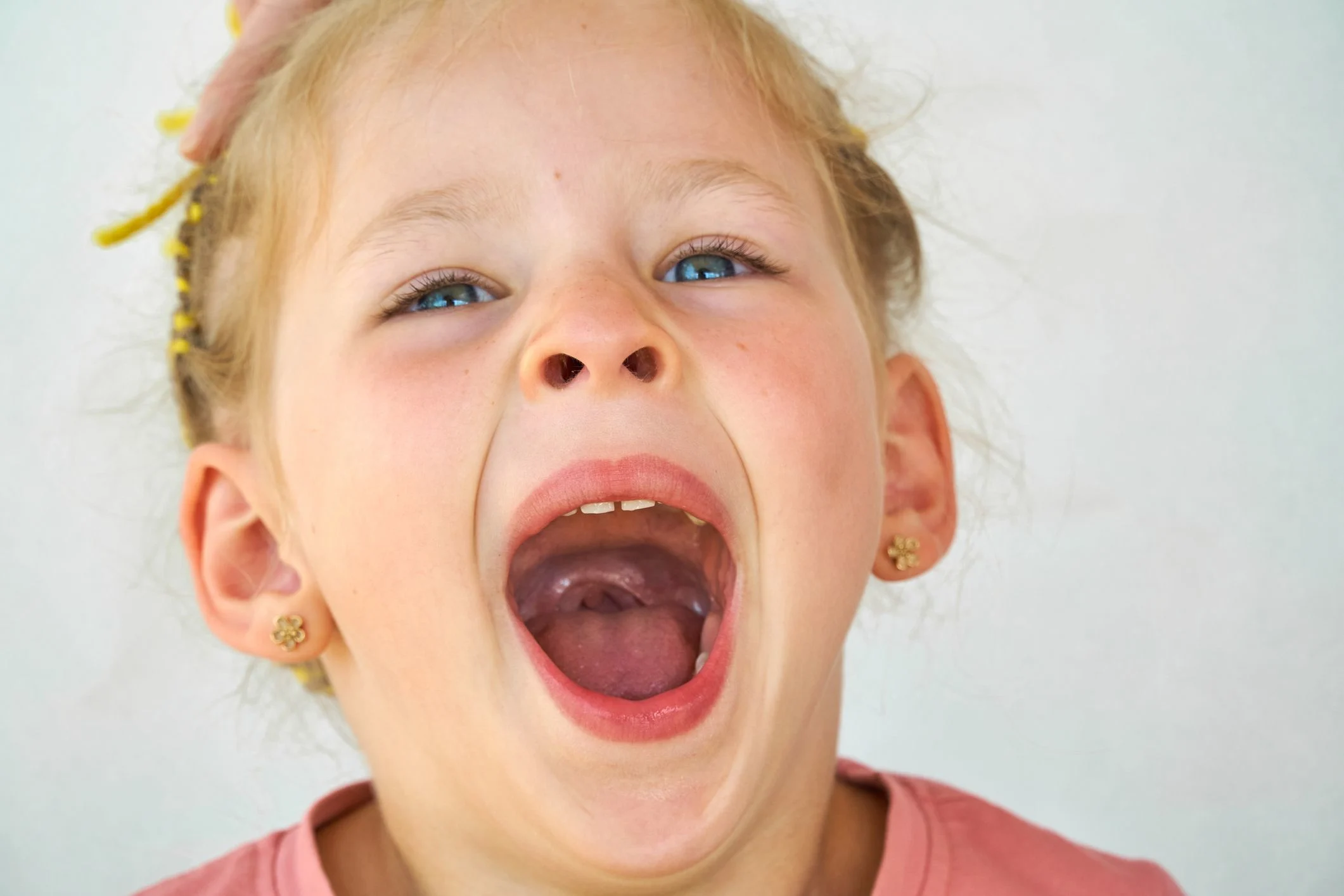 En liten flicka gapar stort. Långt bak i halsen ser man att det är trångt och svullet.