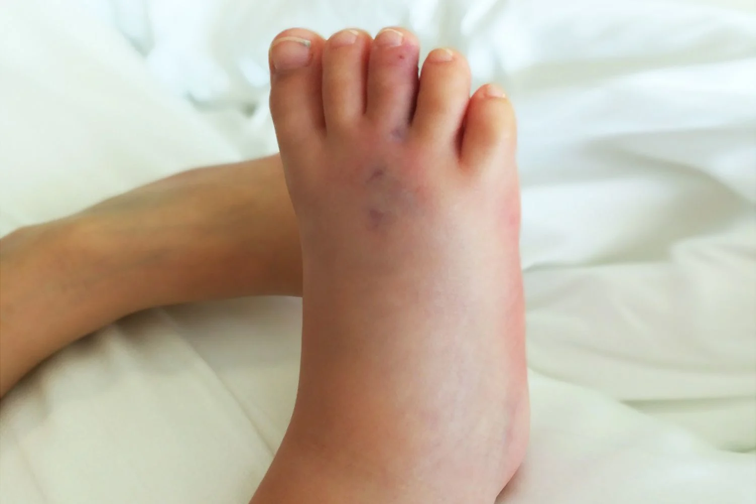 Mycket svullen och röd fot på ett barn. Två märken efter tänderna på en orm.