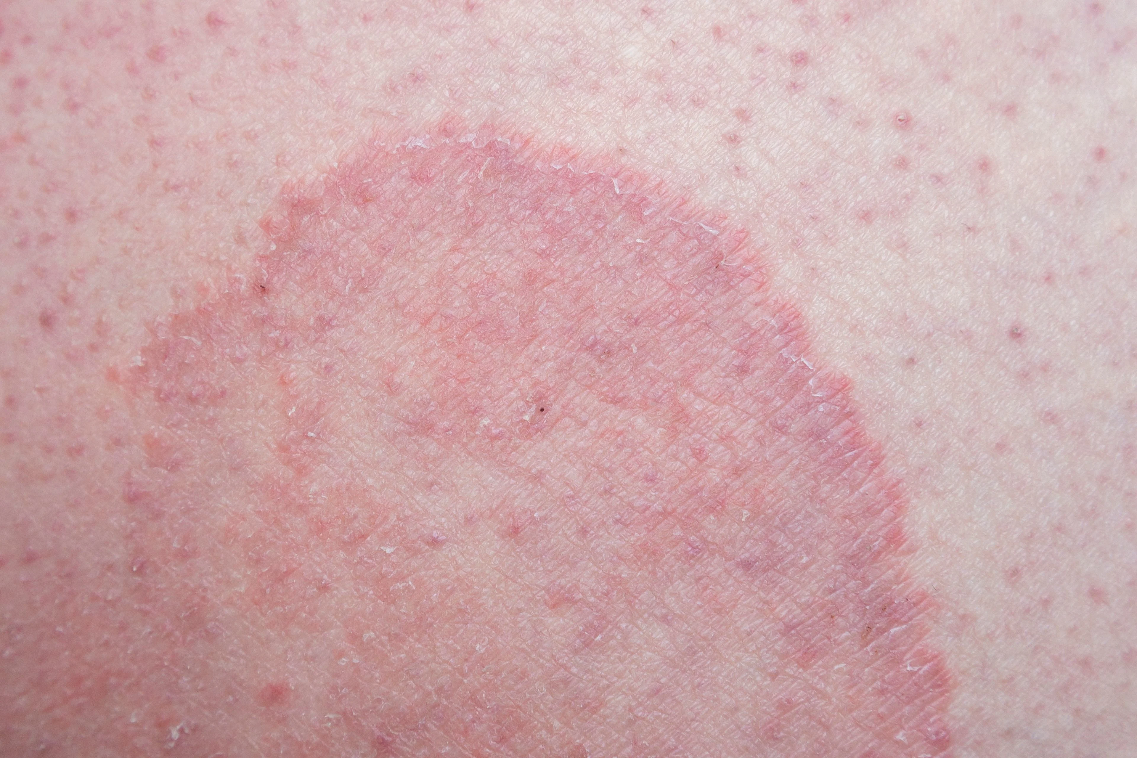 Hud med rött märke orsakat av svamp.