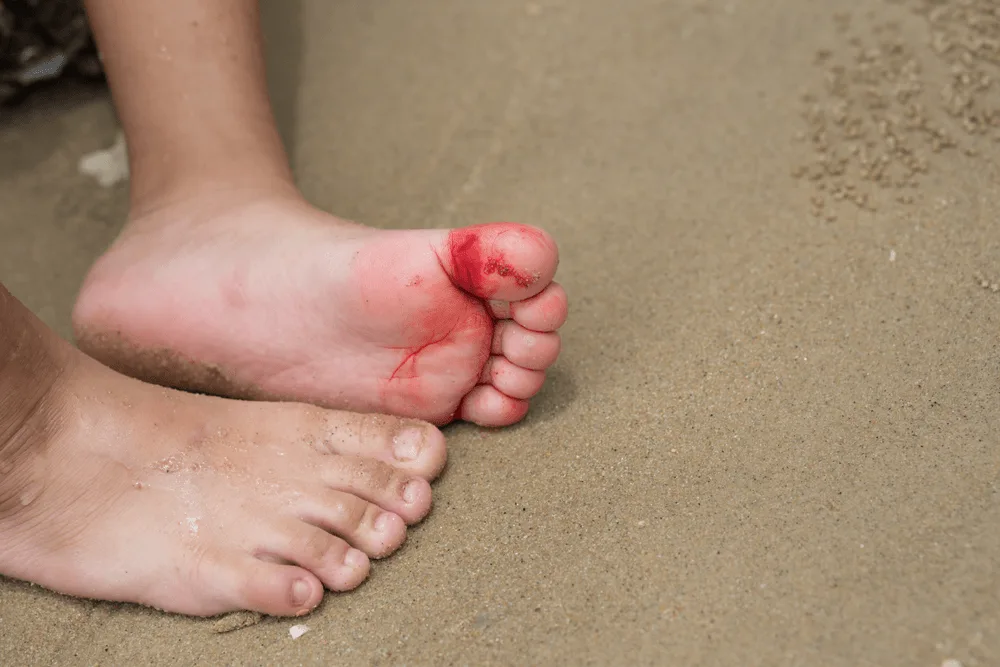 Sårskada som blöder på ett barns tå.