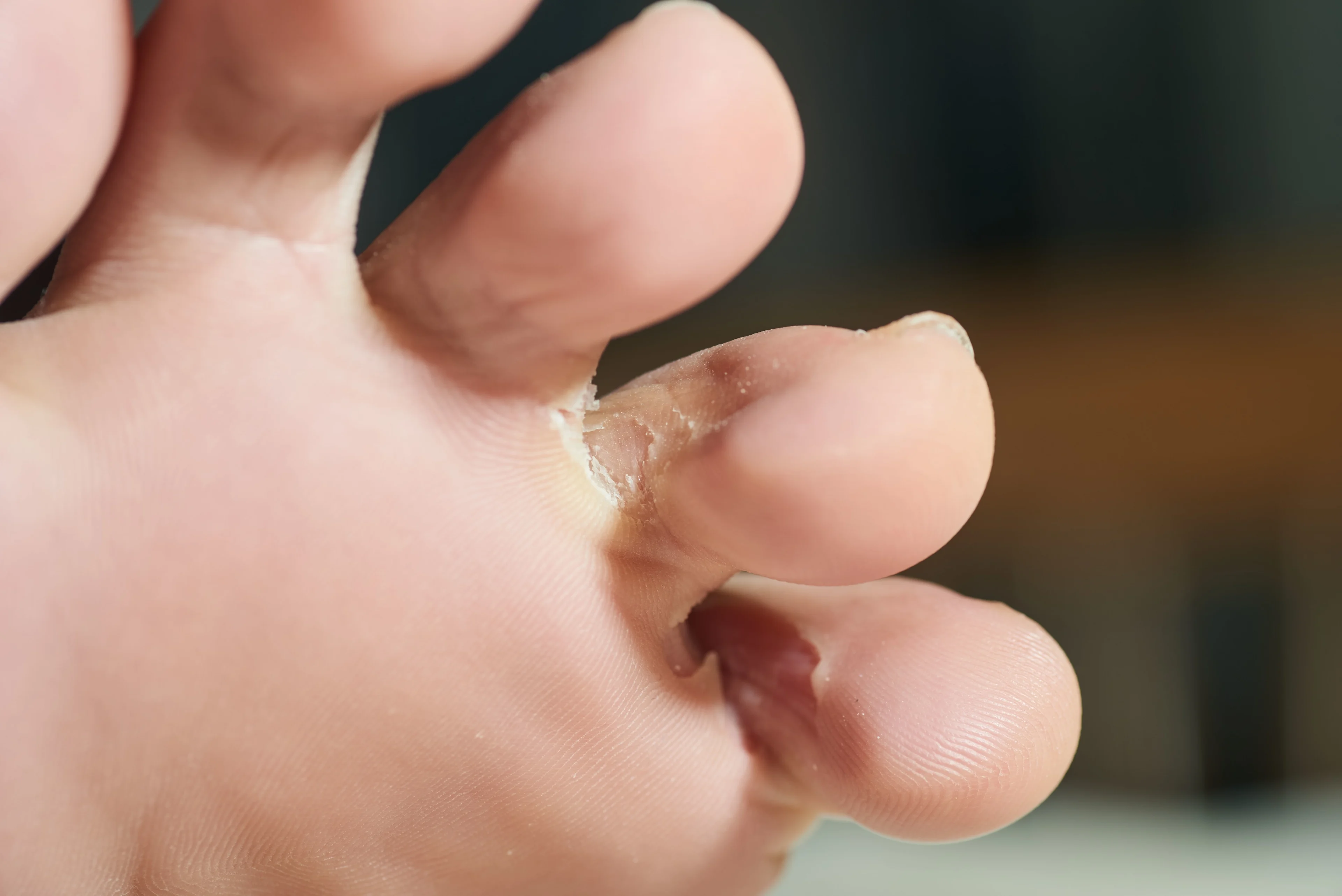 Närbild på en fot med uppluckrad hud mellan tårna.