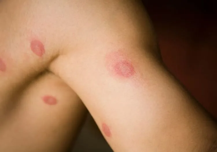 Runda röda märken på huden under och på armen på ett barn.