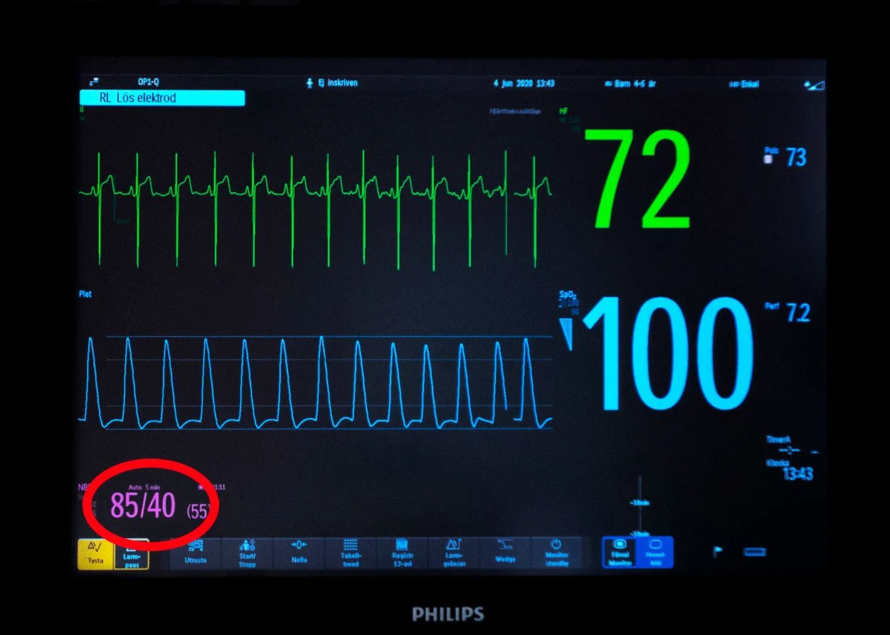 Övervakningsskärm med blodtrycksvärdet inringat.