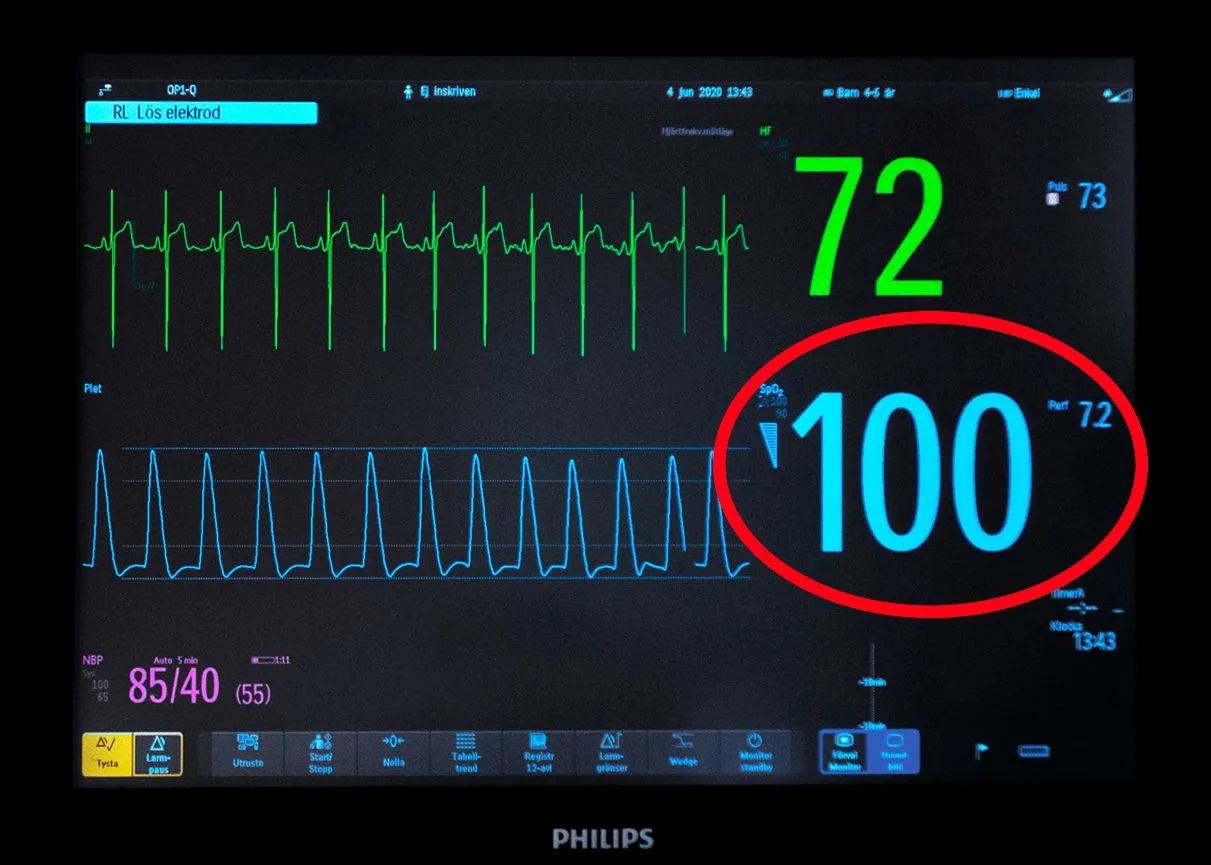 Övervakningsskärm med värdet för syremättnad inringat.