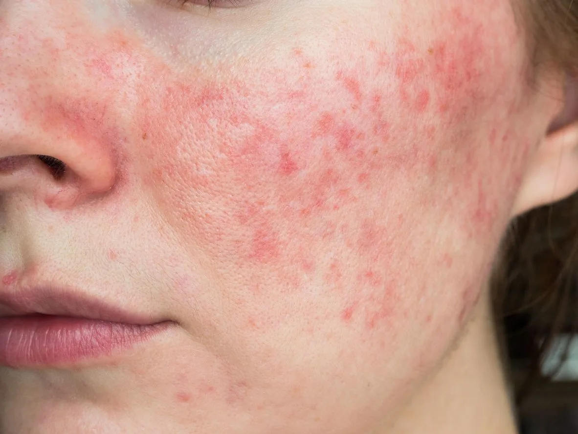 En tjej med röda utslag av rosacea på kinden och näsan.