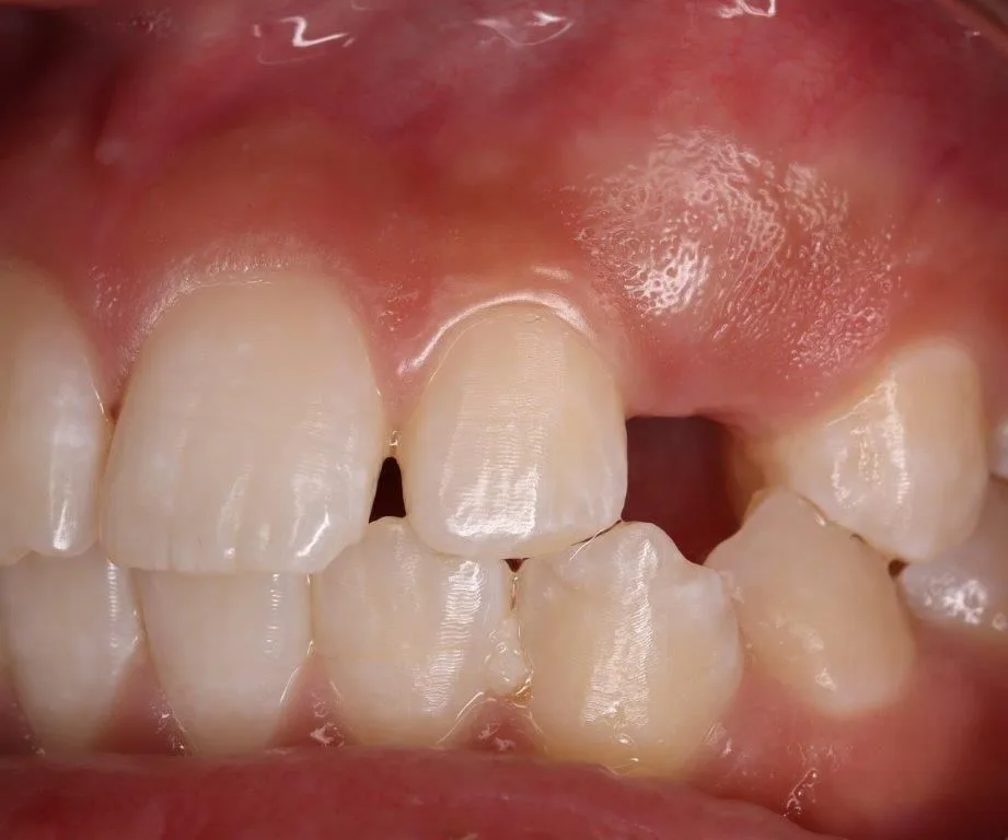 Närbild på tänder i överkäke. En tand som inte har kommit fram.