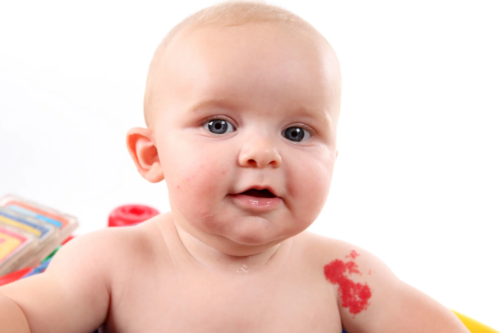 Rose Birthmark Port-Wine Stain | MediPrep